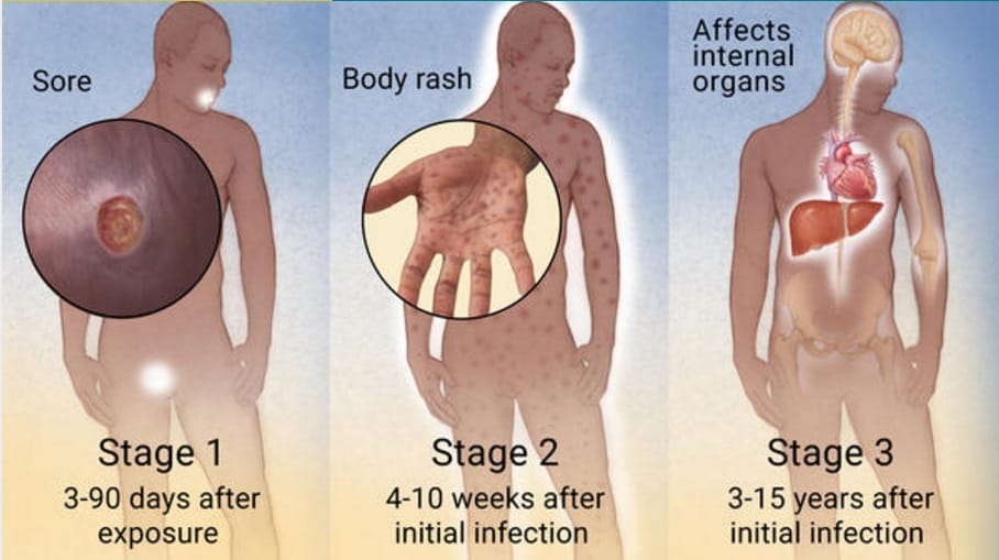 Stages of Syphilis with symptoms